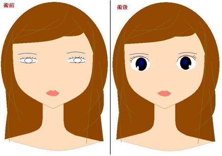 三点定位双眼皮术后-三点定位双眼皮手术：痛苦与美丽交织的蜕变之旅